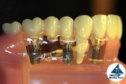 TOP QUALITY DENTAL IMPLANTS JUST FROM £355*