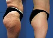 Fat loss & Cellulite Treatment    075 872 718 23      www.fatlossstudio.jimdo.com