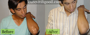 Vitiligo Treatment