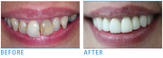 Option for teeth whitening Kingston services for Getting Back Spark