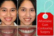 Experienced Cosmetic Dentist in London for Gum Contouring Surgery