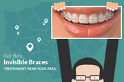 Ease and comfort of Invisible Braces in London