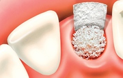 Encourage your surrounding Bone before Dental Implant | Bone Grafting