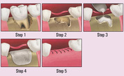 Are You a Perfect Candidate for Bone Grafting