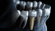 Dental Implant Services in Budapest and London