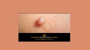 Skin Tag Removal | London Dermatology Clinic