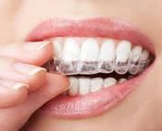 Invisalign to Straighten Smile