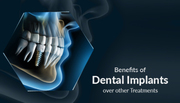 Don’t Miss a Moment… Get a Dental Implant Today...