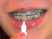 Keep Calm and Get Braces with Hungary Dental Implant