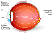 Glaucoma Referral Refinement