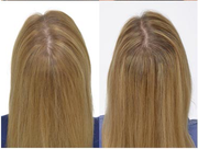 Innovative IGrow Hair Thinning Treatment System 