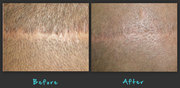 Hair replacement treatment in London,  UK