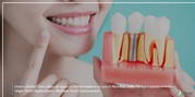 Why you need to get dental implants in India