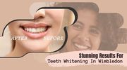 Stunning results for teeth whitening in Wimbledon