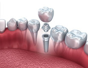 Best Tooth Implant Cost In Delhi | Dental Clinic