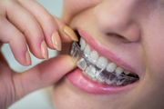 Dental Braces Enhance Your Smile with Invisible One