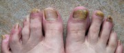 Antifungal Foot Care Serum - Scientific- https://tinyurl.com/fhtdc8w