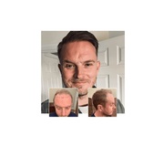 Capital Hair Restoration Hair Transplant Harley Street